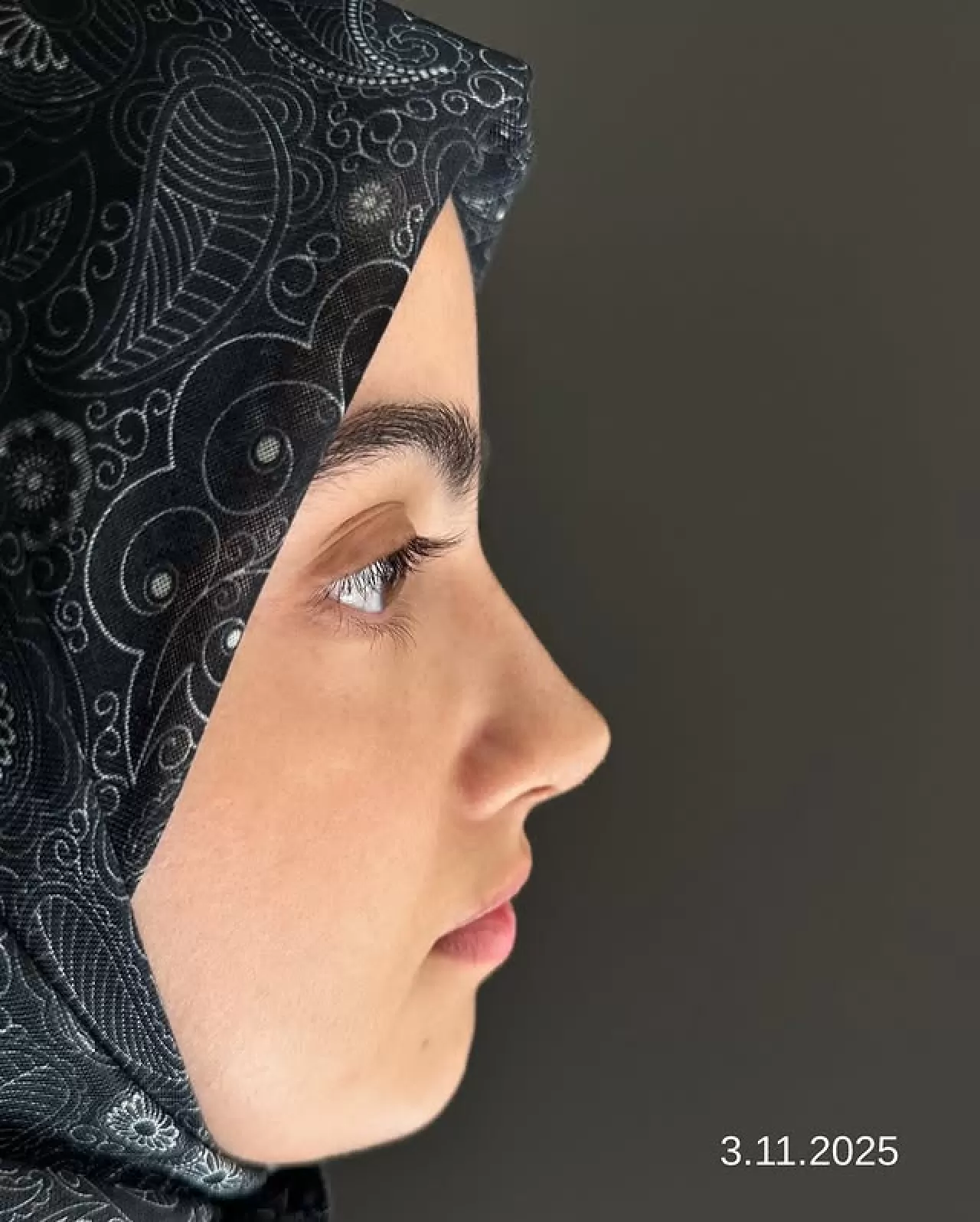 Kapadokya'da Burun Estetiği Ameliyatlarında Yeni Dönem: Piezo Tekniği ile Doğal Sonuçlar