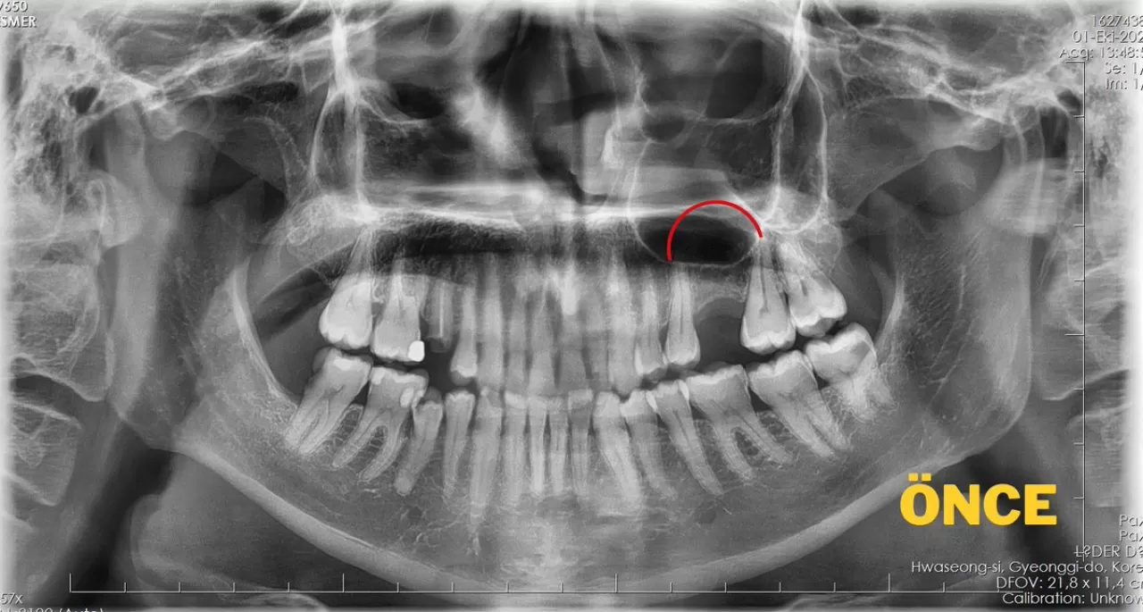 Batman'da İlk Açık Sinüs Lift Ameliyatı Başarıyla Gerçekleştirildi