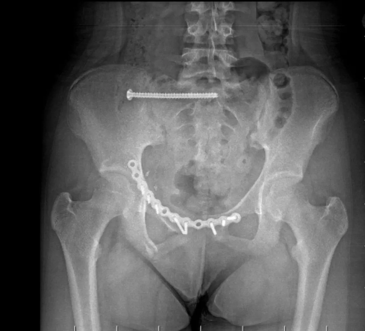 Batman'da Genç Hastanın Karmaşık Leğen Kemiği Kırığı Başarıyla Ameliyat Edildi