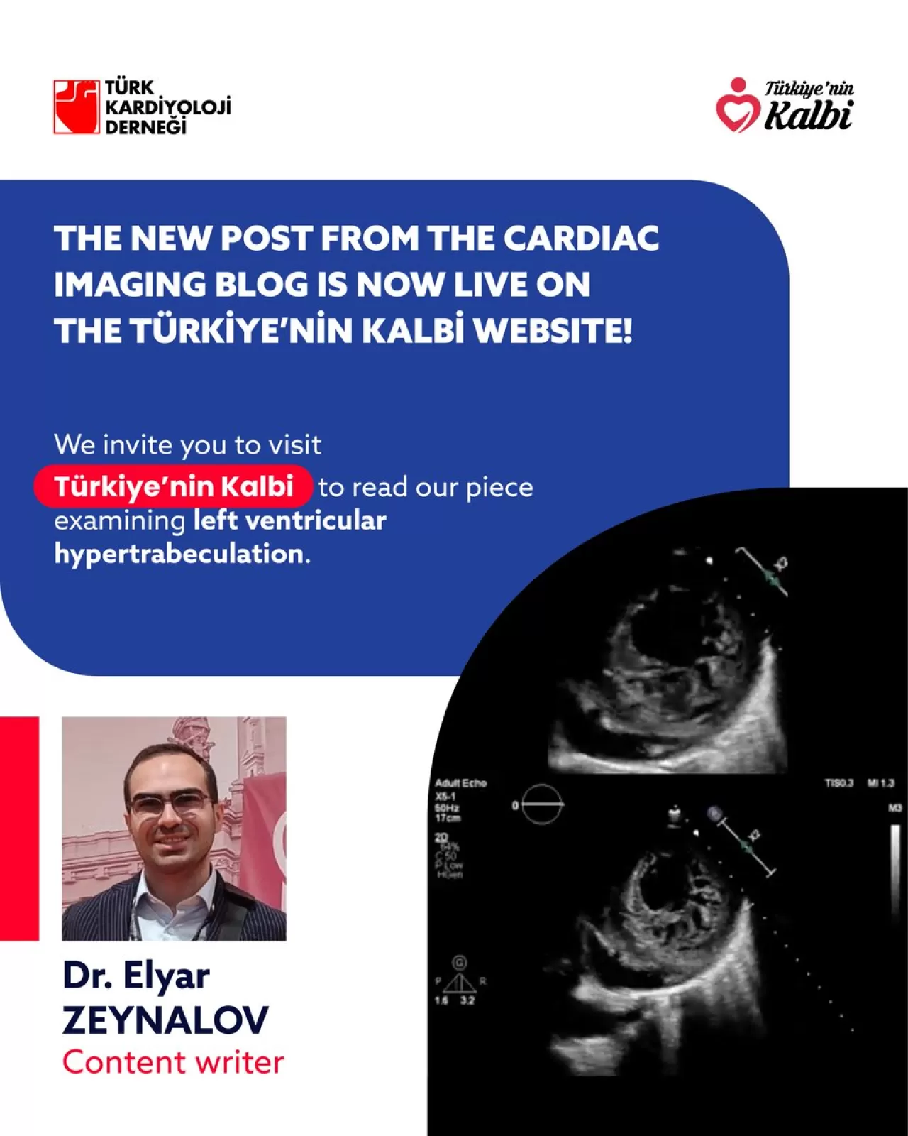 Sol Ventriküler Hipertrabekülasyon Nedir? Türk Kardiyoloji Derneği Uzman Girişi ile Erişime Açıldı