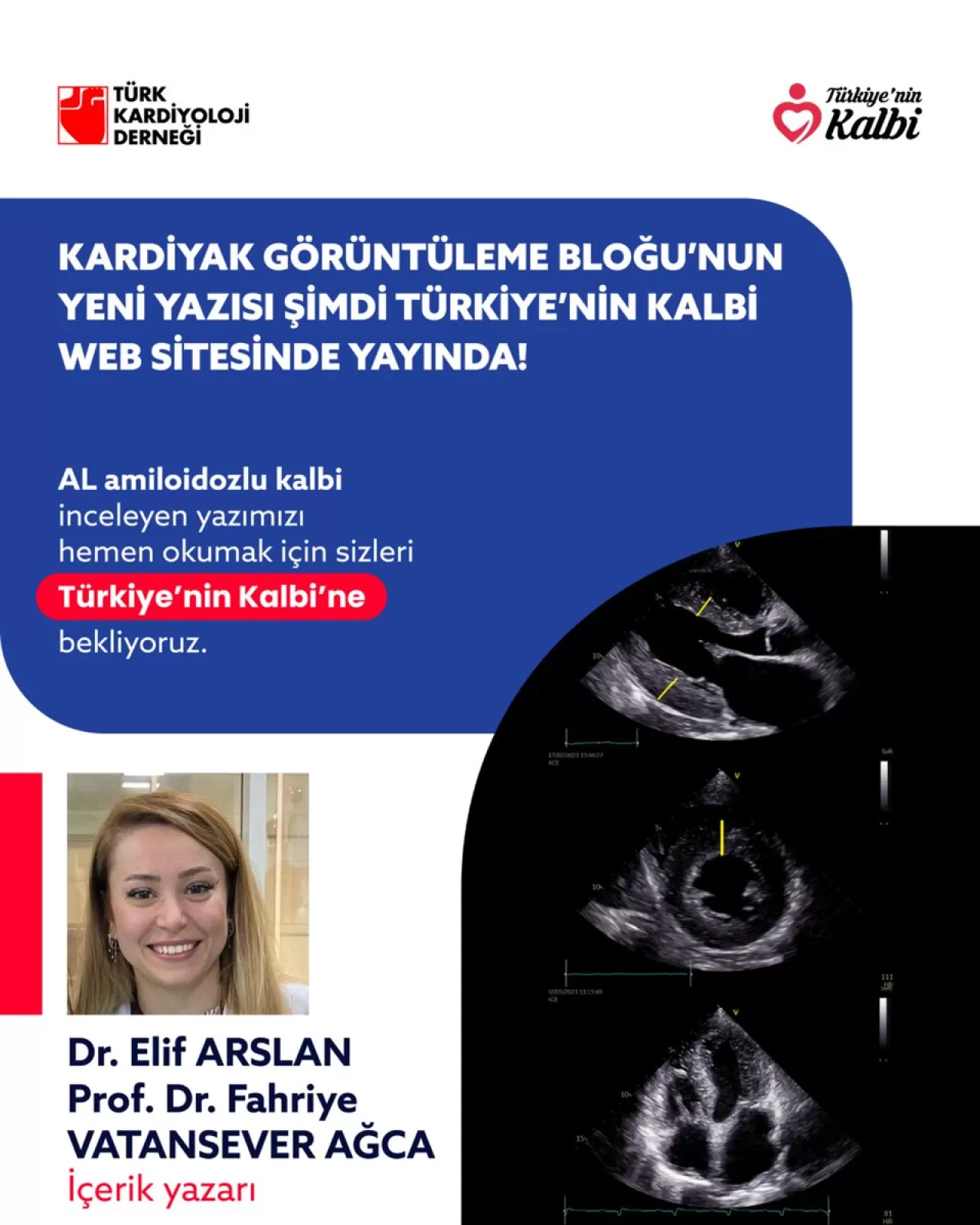 AL Amiloidozu Hastalığında Kalp Tutulumu ve Tanı Yöntemleri