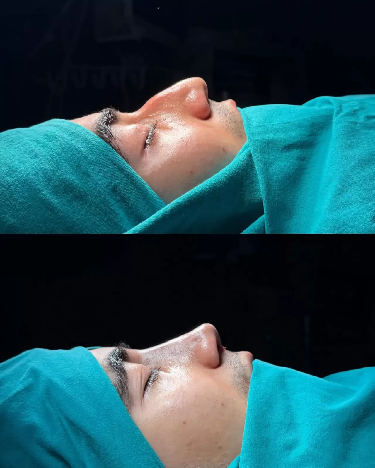 Burun Estetiği ile Hem Fonksiyon Hem Estetik Kazanımı