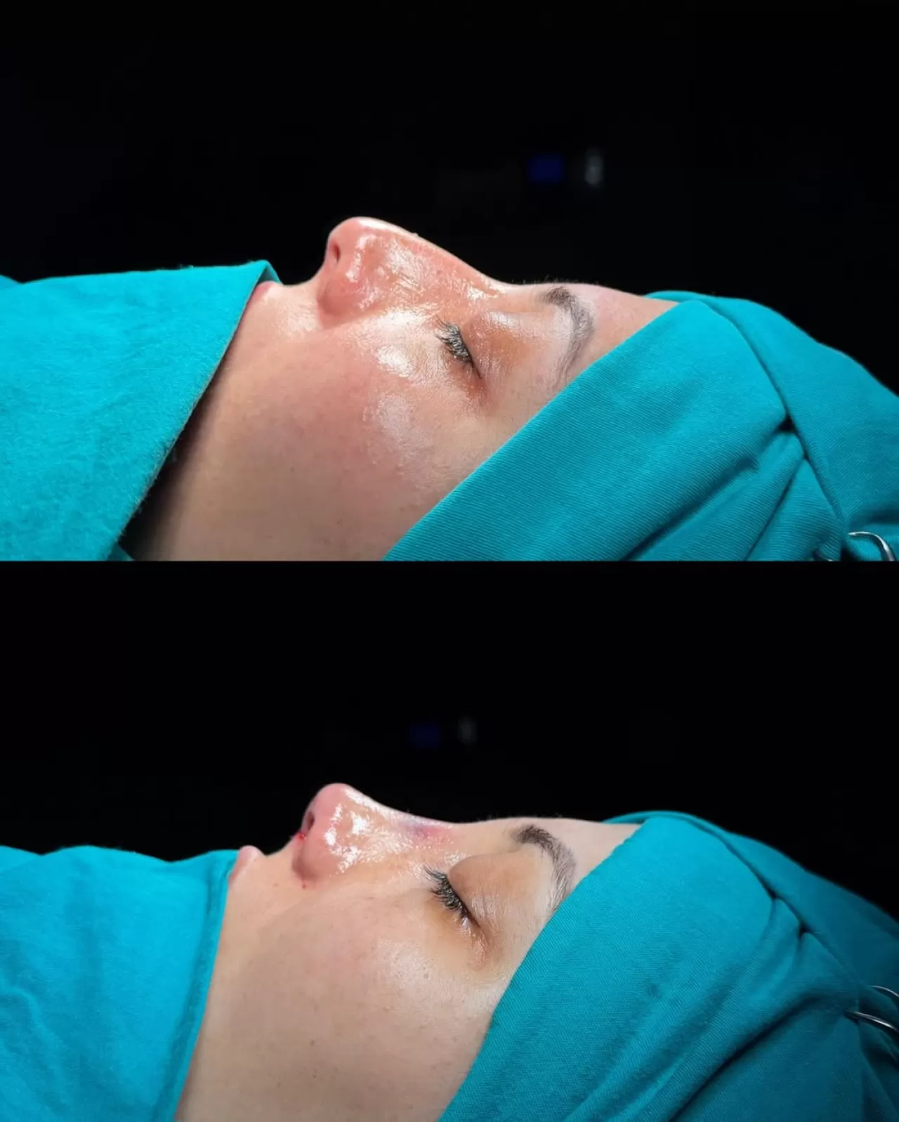 Ankara'da Septorinoplasti ile Doğal Görünüme Kavuşmanın Yolu