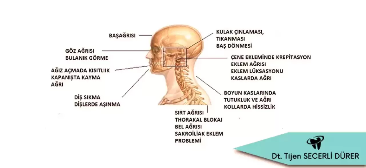Çene Eklemi Sesleri İhmal Edilmemesi Gereken Sessiz İşaretler Olabilir