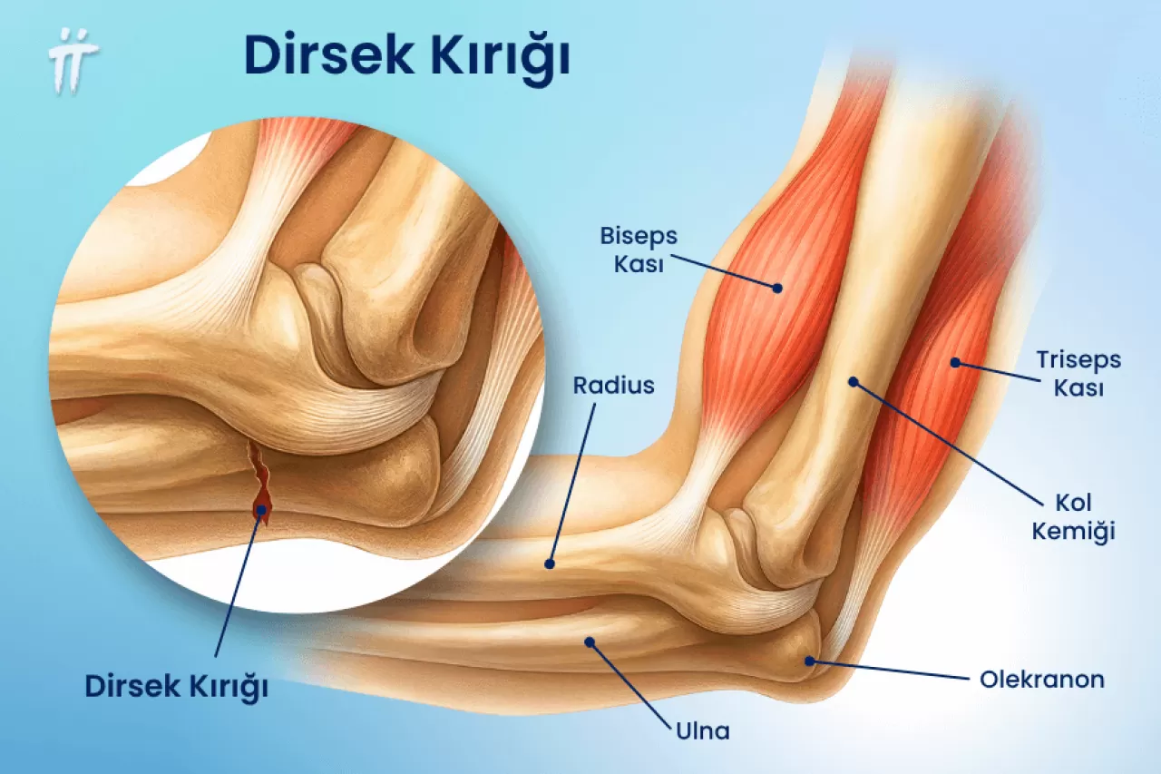 Günlük Yaşamın Sessiz Tehlikesi: Kronik Dirsek Ağrısı ve Mekanik Stres