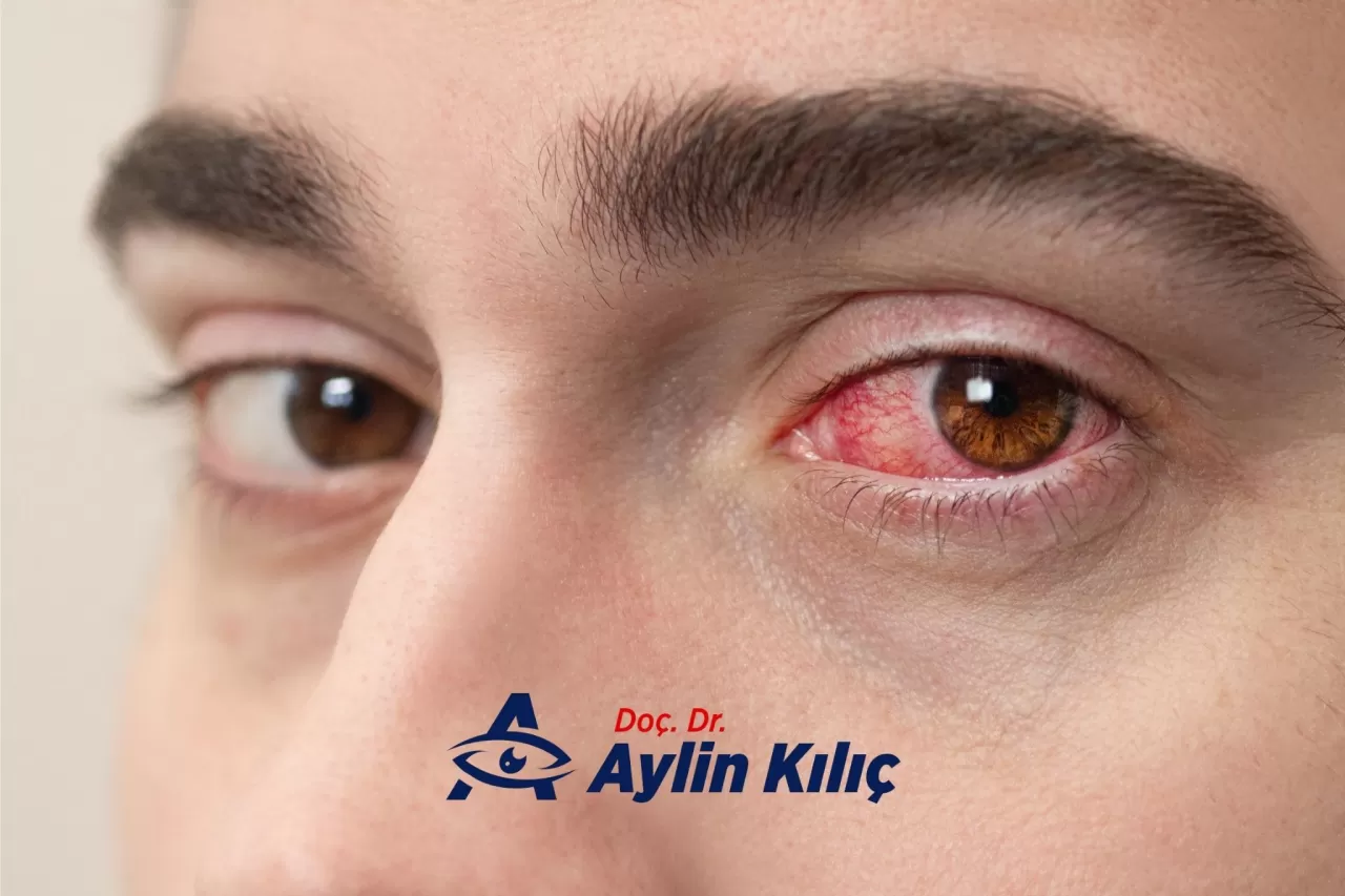 Kronik Göz Kızarması, Vücuttaki 