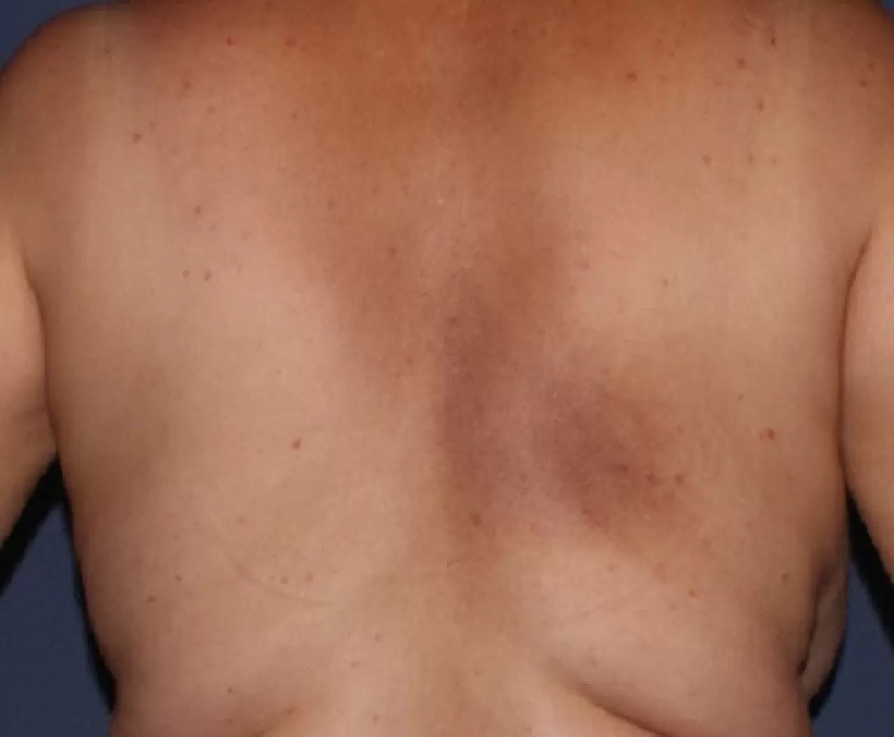 Geçmeyen Sırt Kaşıntısı Sinir Hasarının İşareti Olabilir