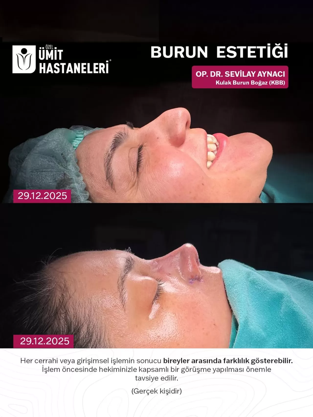 Özel Ümit Hastanesi'nde Doğal Görünümlü Rinoplasti Uygulamaları