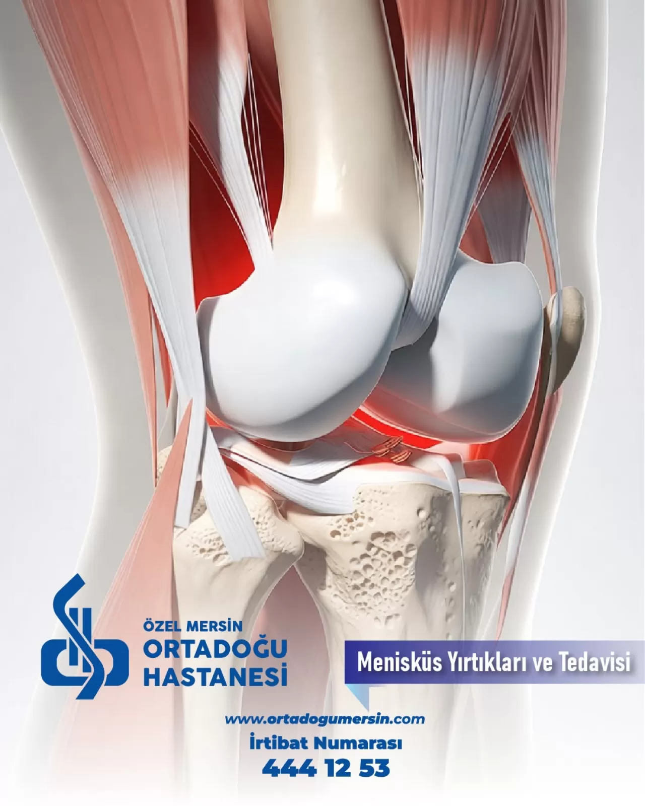 Menisküs Yırtıkları: Belirtileri, Tedavi Yöntemleri ve Önleme Yolları