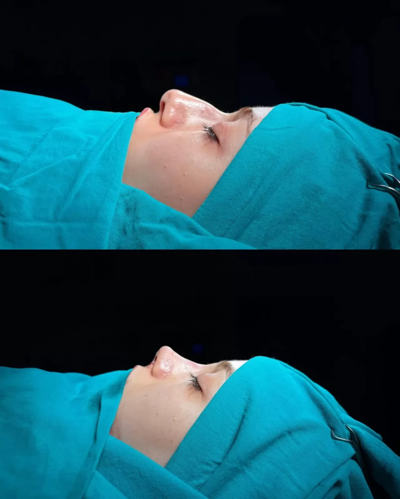 Ankara'da Profesyonel Rinoplasti Ameliyatı ile Doğal Sonuçlar