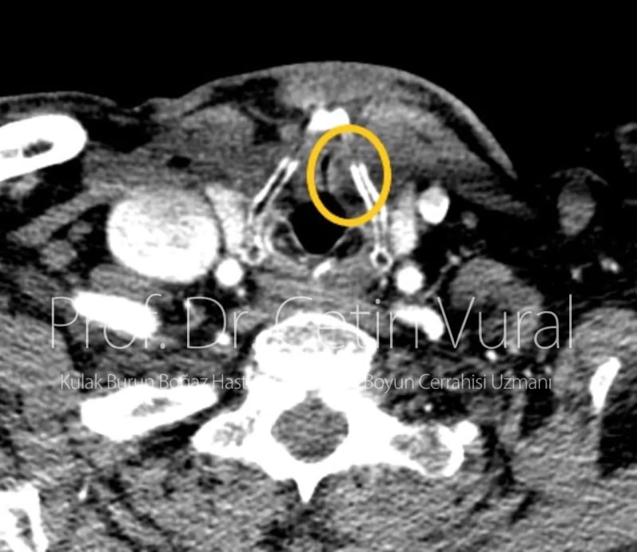 Sesinizdeki Gizli Tehlike: Kronik Hafif Ses Kısıklığına Dikkat