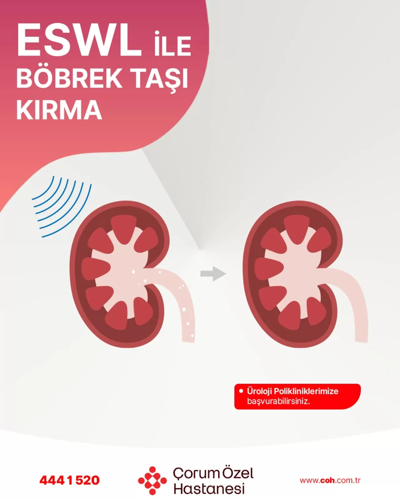 Çorum Özel Hastanesi'nde Modern Yöntemle Böbrek Taşı Tedavisi