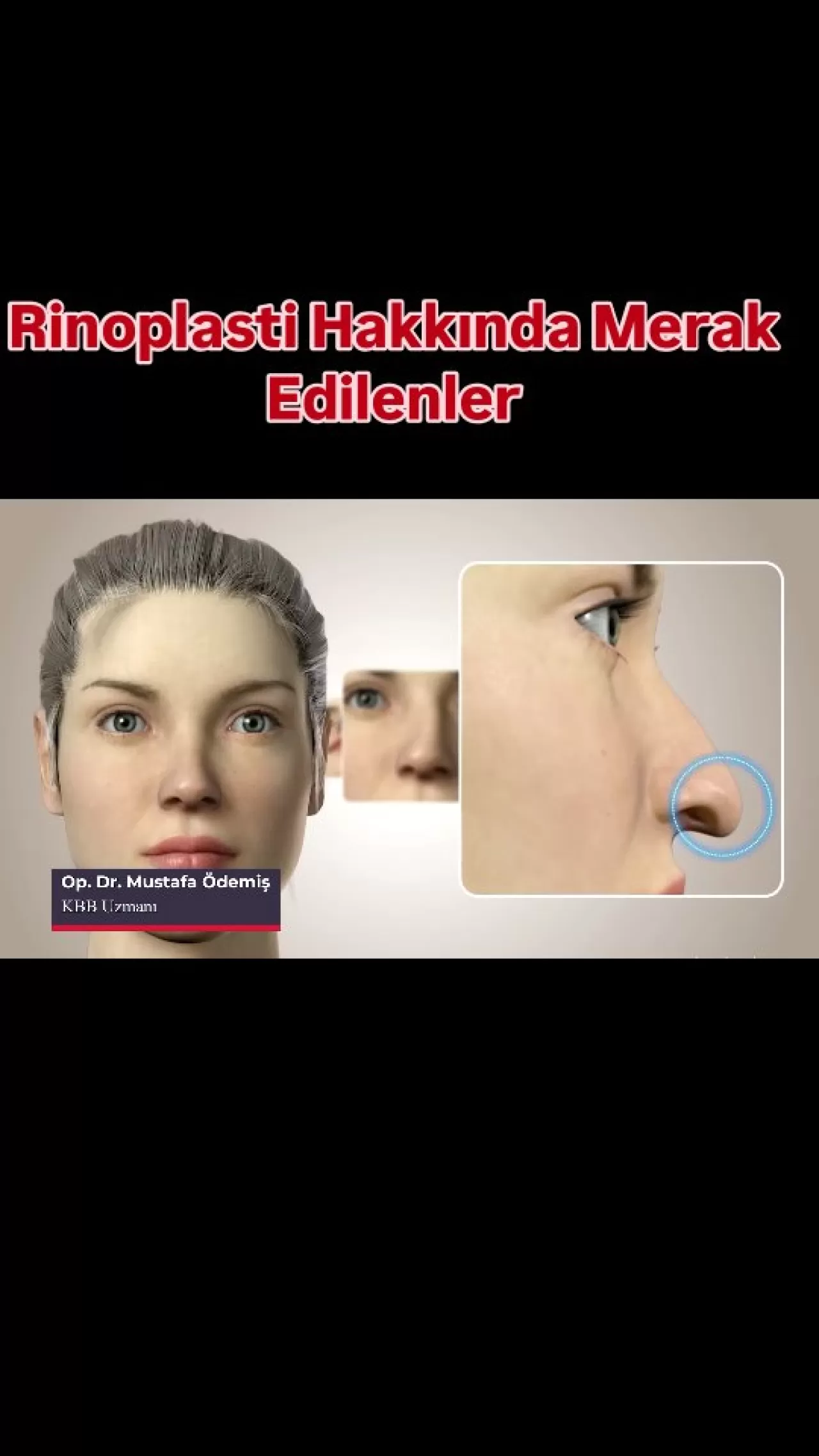 Rinoplasti (Burun Estetiği) Hakkında Tüm Merak Edilenler Yanıt Buluyor