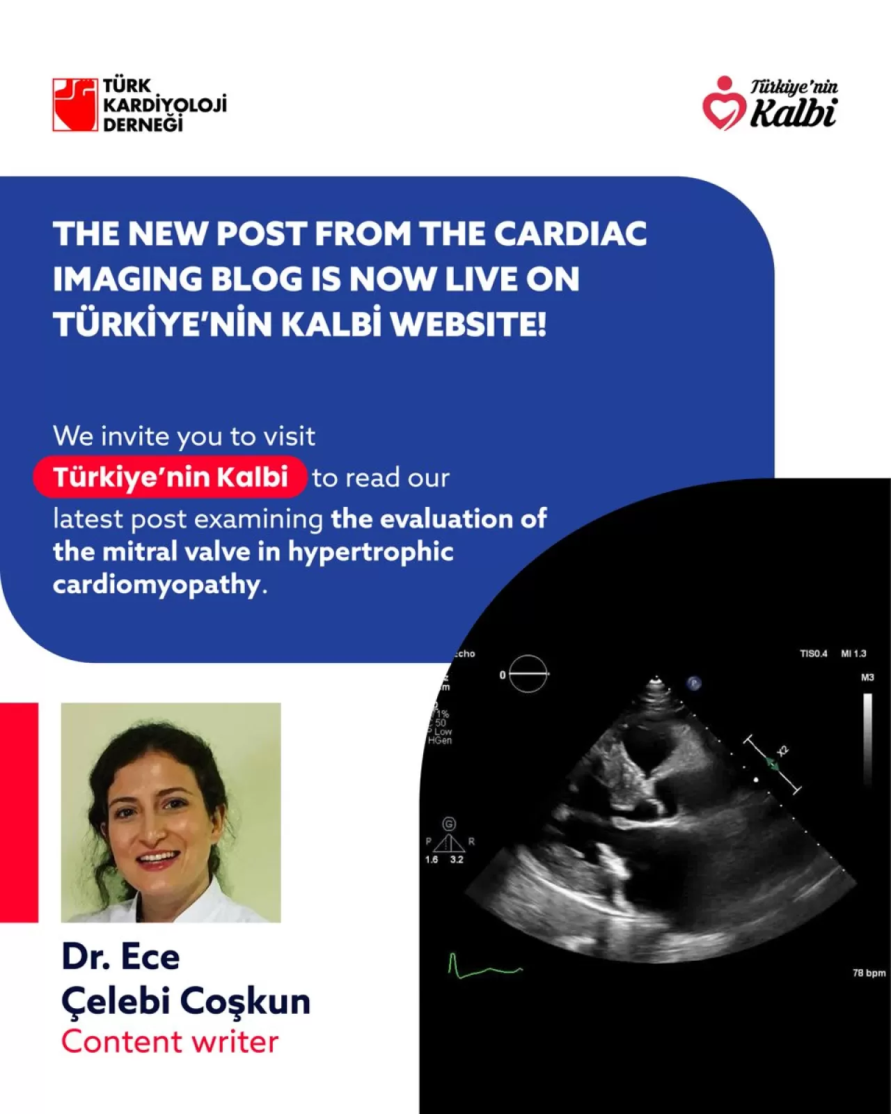 Hipertrofik Kardiyomiyopatide Mitral Kapak Değerlendirmesi Türk Kardiyoloji Derneği'nce Paylaşıldı