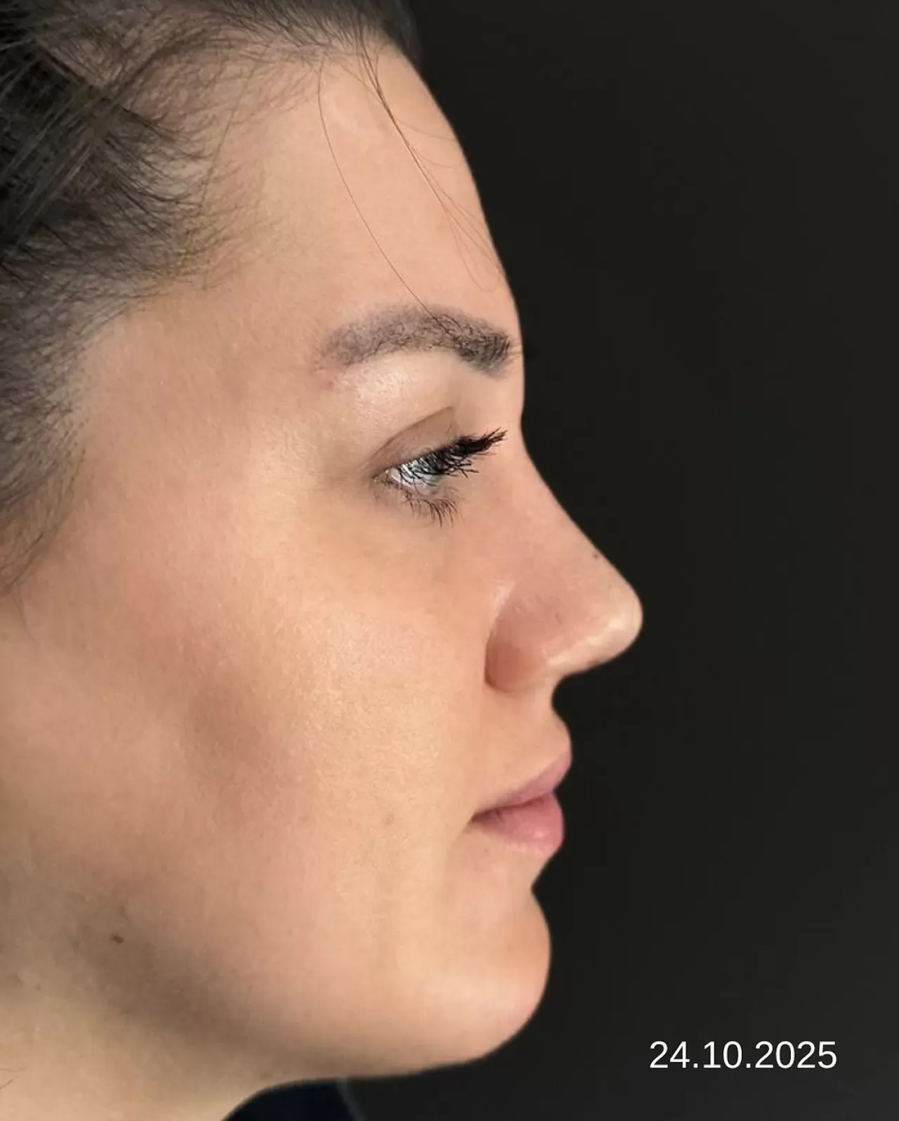 Kapadokya'da Gerçekleştirilen Burun Estetiği Ameliyatının 3 Aylık Kontrolü Başarıyla Tamamlandı